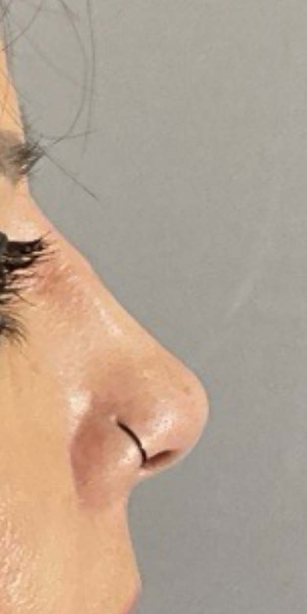 Non-Surgical Rhinoplasty Before & After Image
