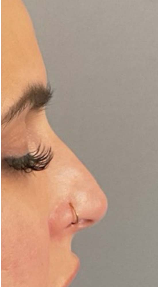 Non-Surgical Rhinoplasty Before & After Image