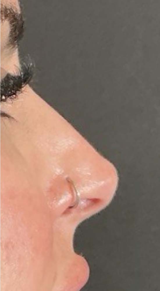 Non-Surgical Rhinoplasty Before & After Image