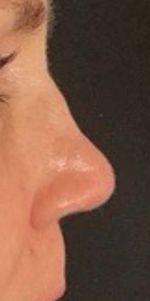 Non-Surgical Rhinoplasty Before & After Image