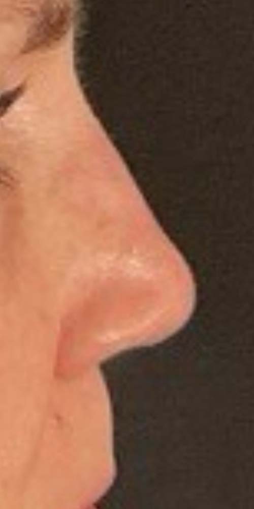 Non-Surgical Rhinoplasty Before & After Image