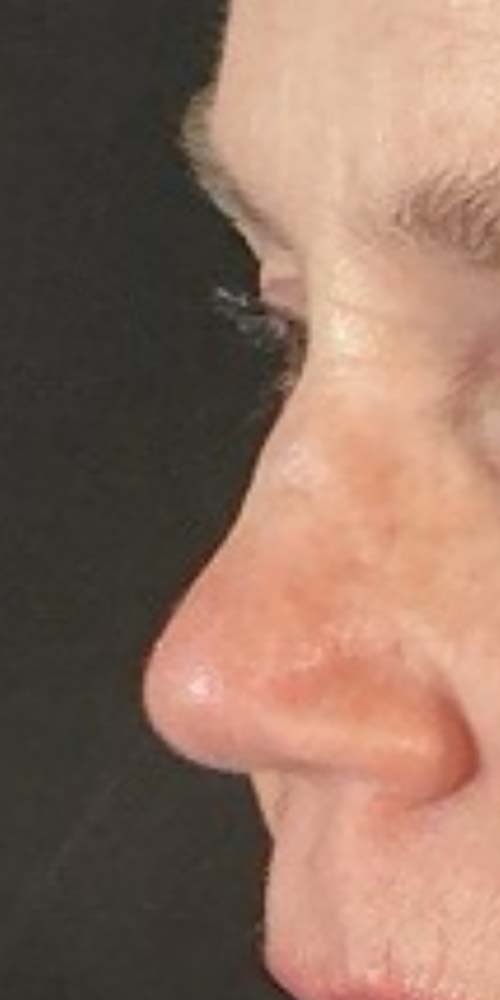 Non-Surgical Rhinoplasty Before & After Image