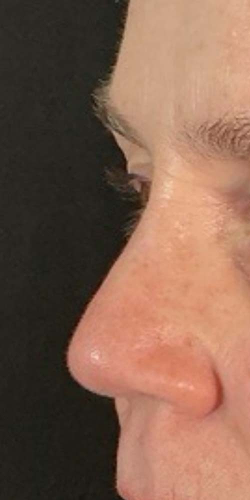 Non-Surgical Rhinoplasty Before & After Image
