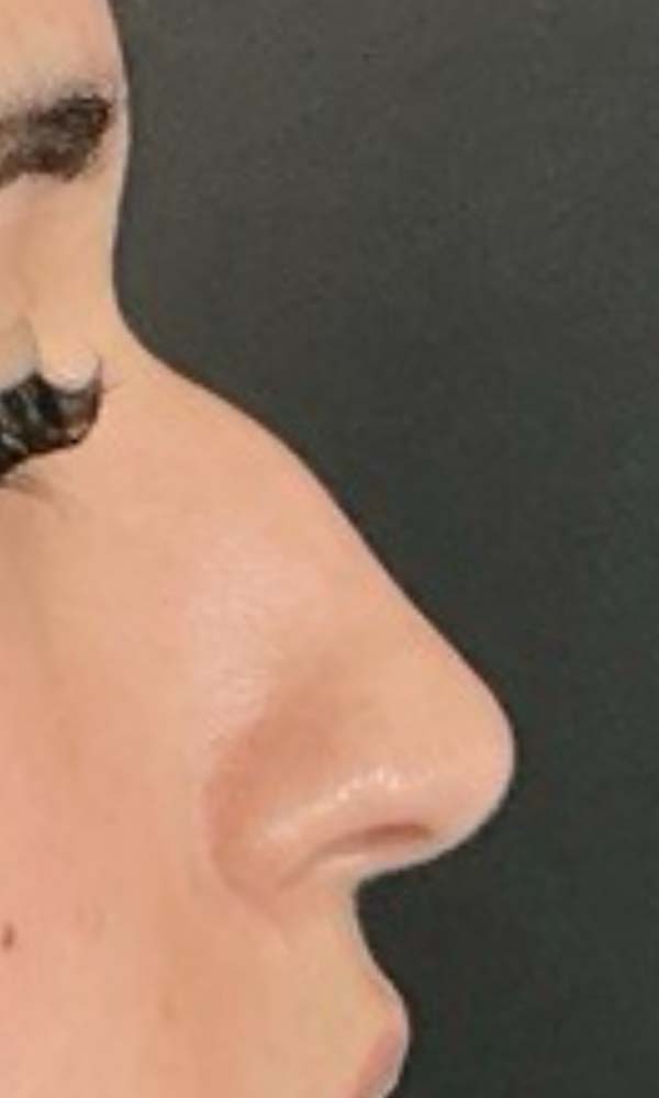 Non-Surgical Rhinoplasty Before & After Image