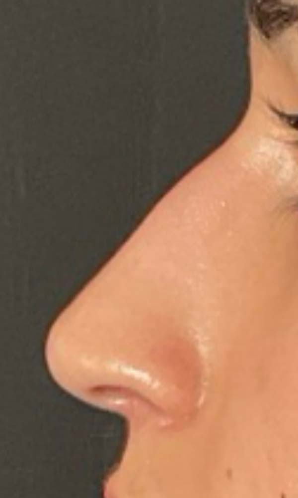 Non-Surgical Rhinoplasty Before & After Image