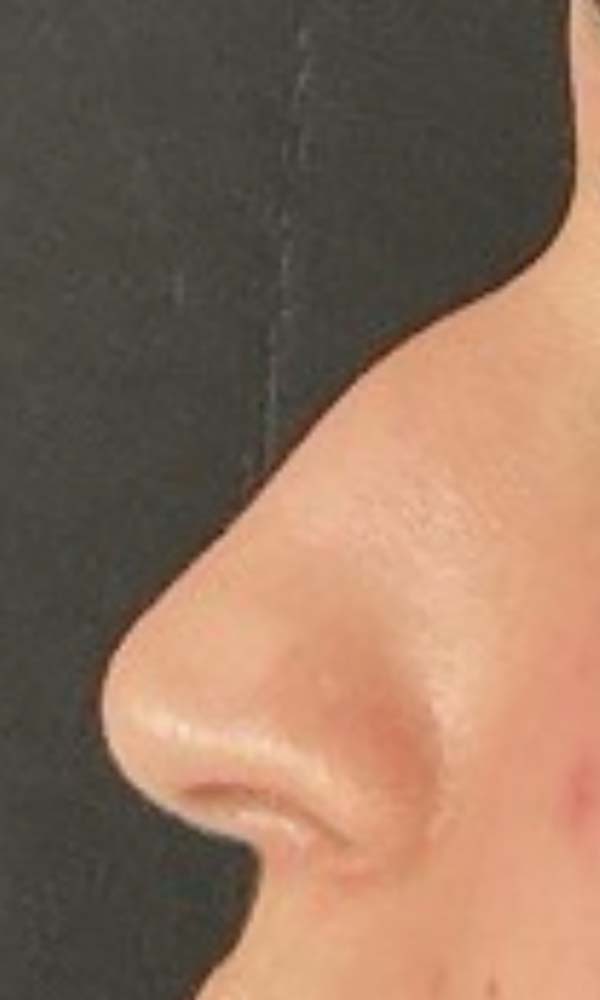 Non-Surgical Rhinoplasty Before & After Image