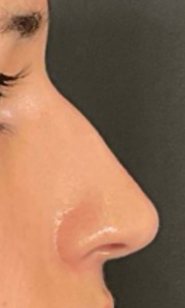 Non-Surgical Rhinoplasty Before & After Image