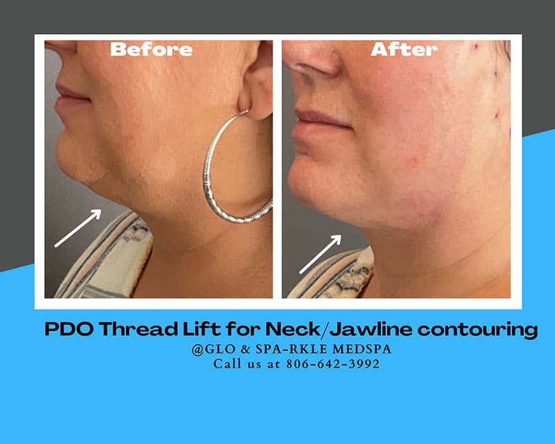 PDO Thread Lift Before & After Image