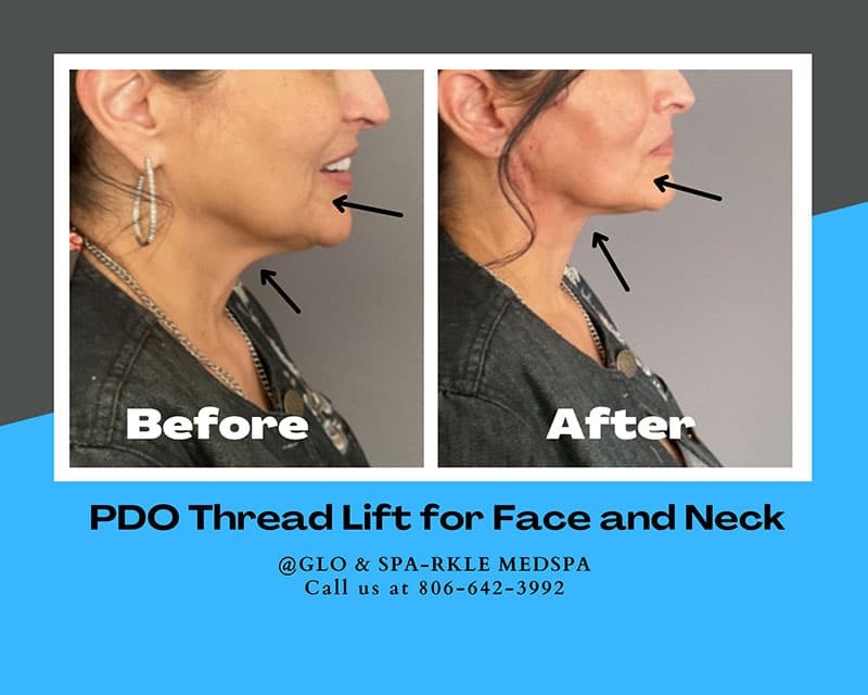 PDO Thread Lift Before & After Image