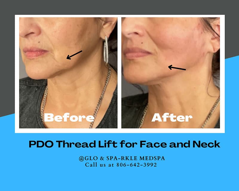 PDO Thread Lift Before & After Image