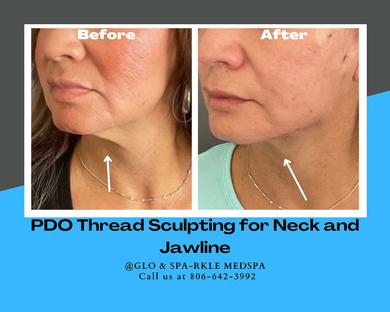 PDO Thread Lift Before & After Image