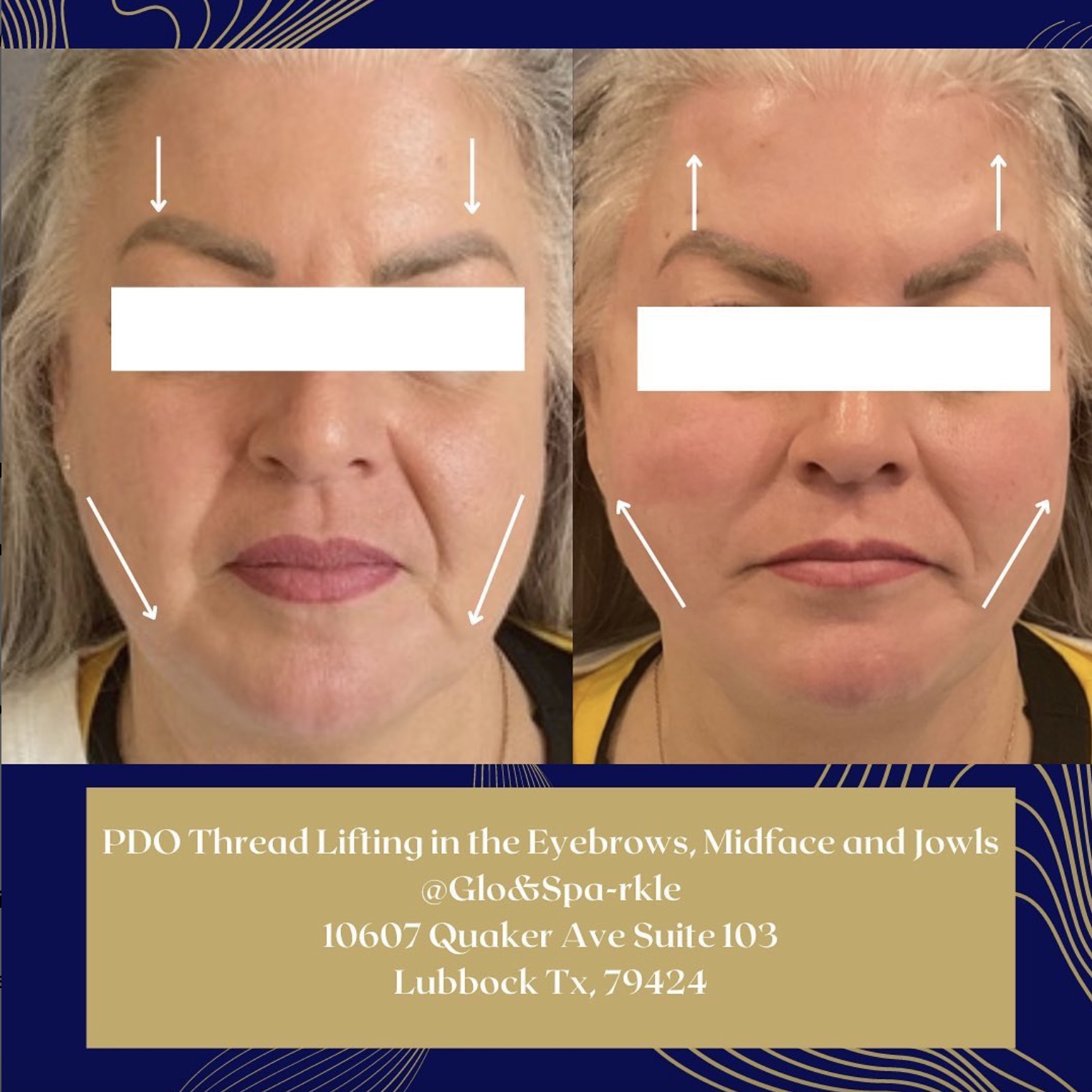 PDO Thread Lift Before & After Image