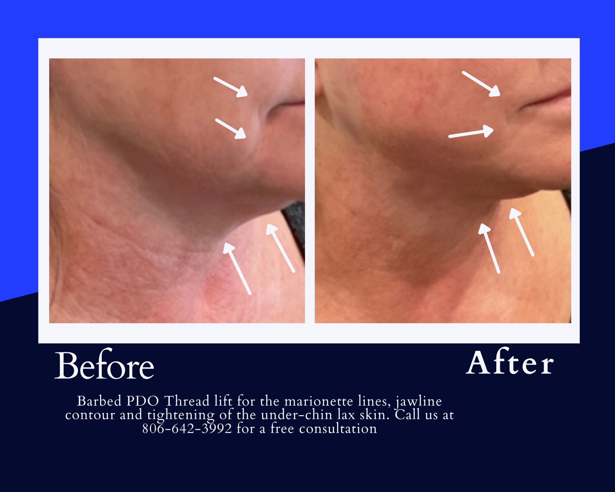 PDO Thread Neck Lift Before & After Image