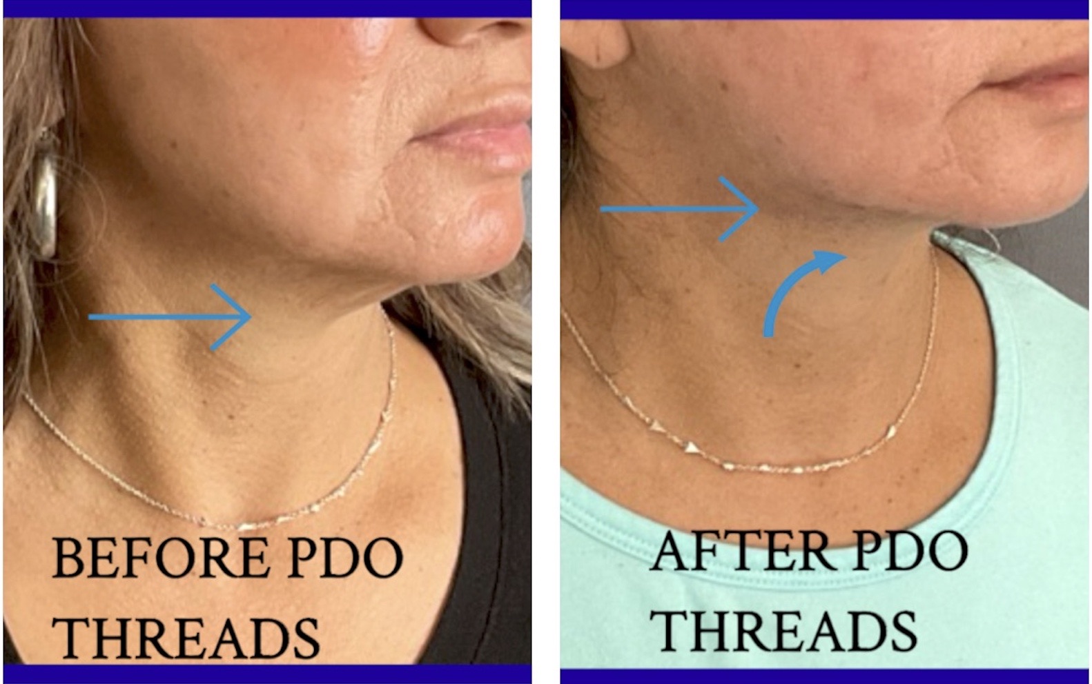 PDO Thread Neck Lift Before & After Image