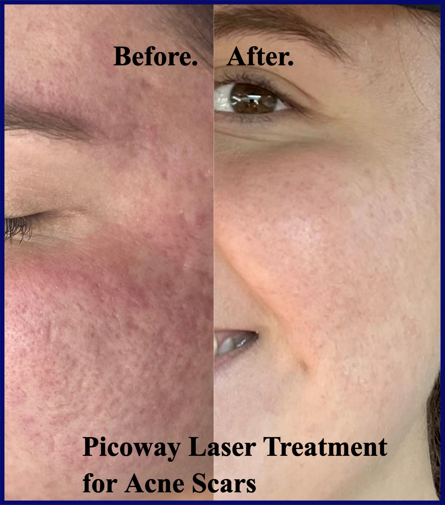 PicoWay Before & After Image