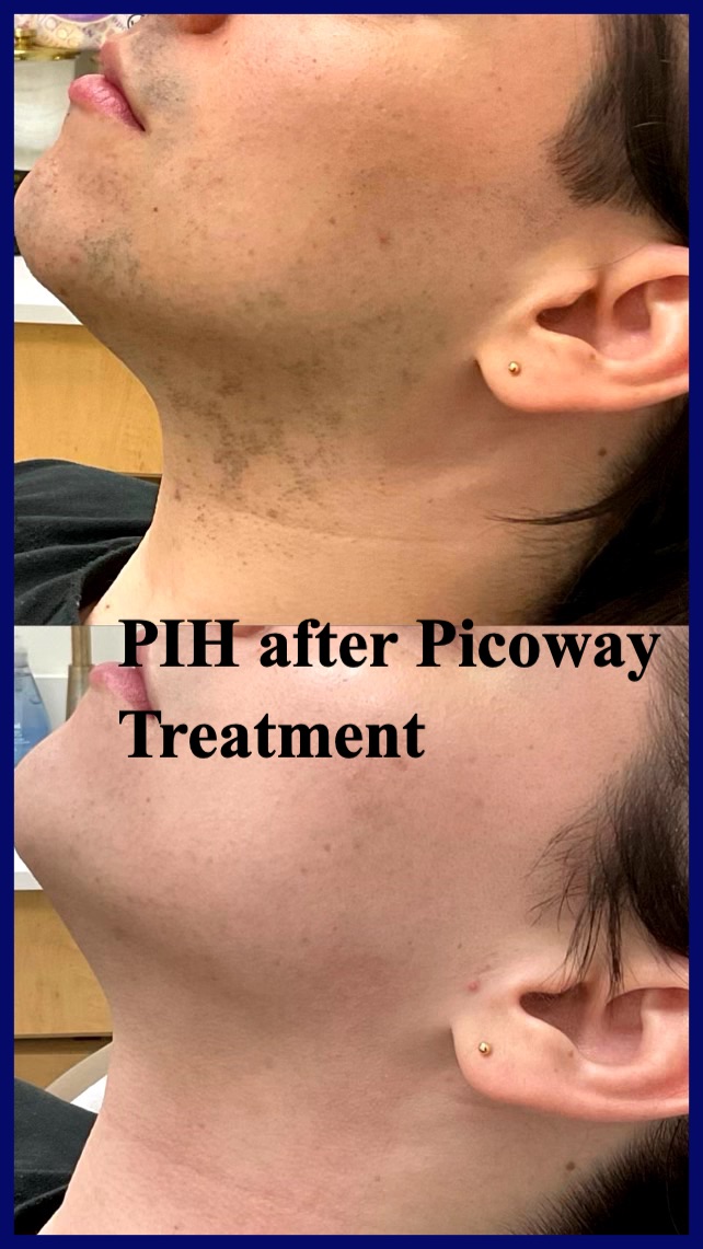 PicoWay Before & After Image