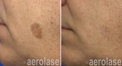 Pigmented Spots Before & After Image