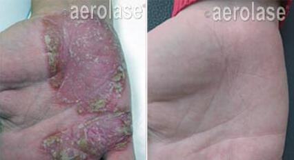 Psoriasis Before & After Image
