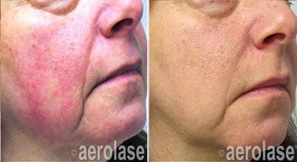 Rosacea Before & After Image