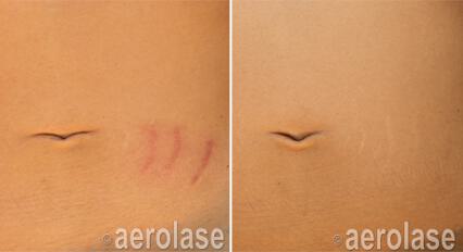 Scar Reduction Before & After Image