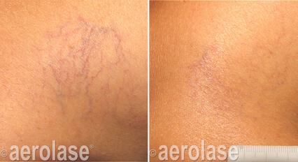 Spider Veins Before & After Image