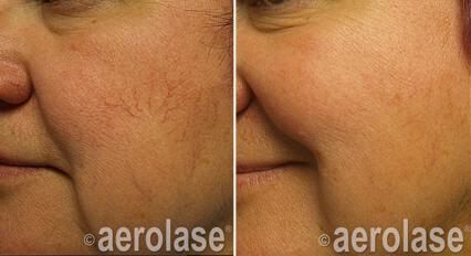 Spider Veins Before & After Image