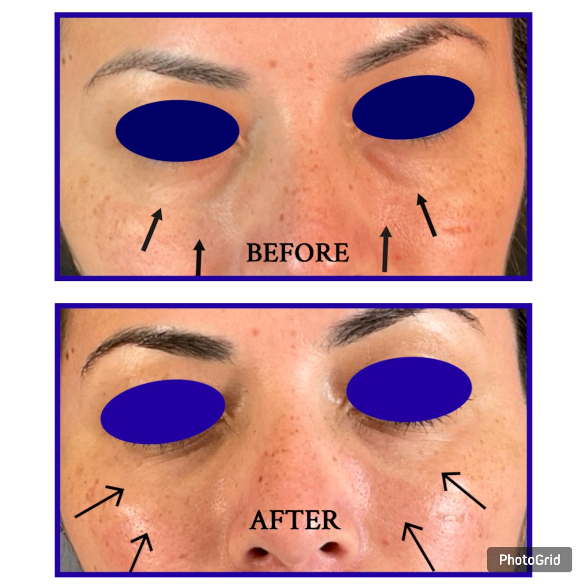 Under-Eye Rejuvenation Before & After Image