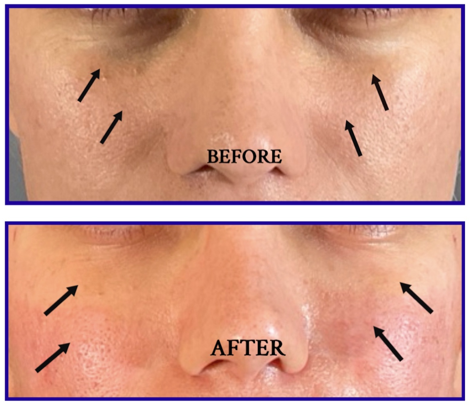 Under-Eye Rejuvenation Before & After Image