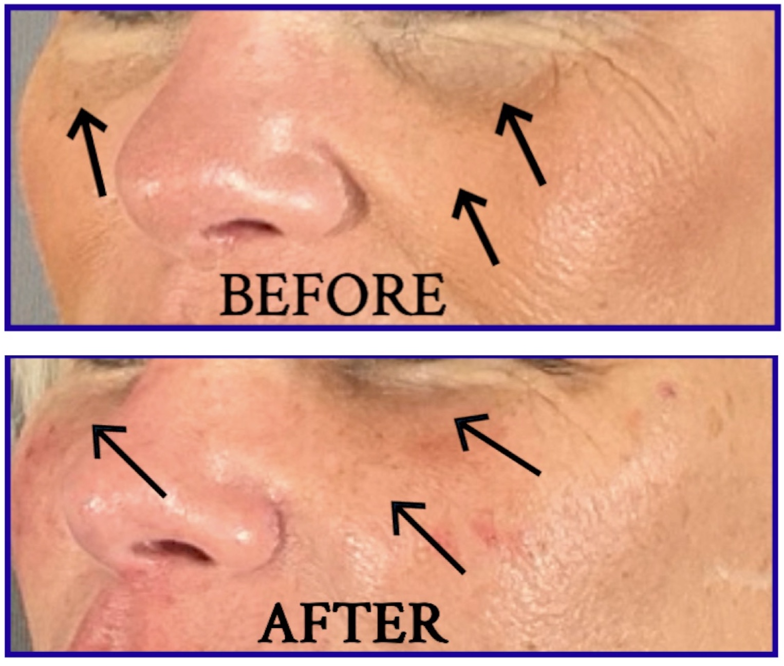 Under-Eye Rejuvenation Before & After Image