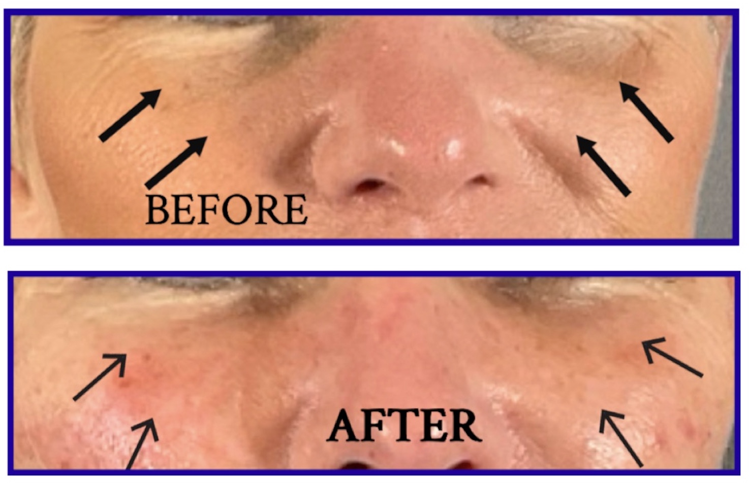 Under-Eye Rejuvenation Before & After Image