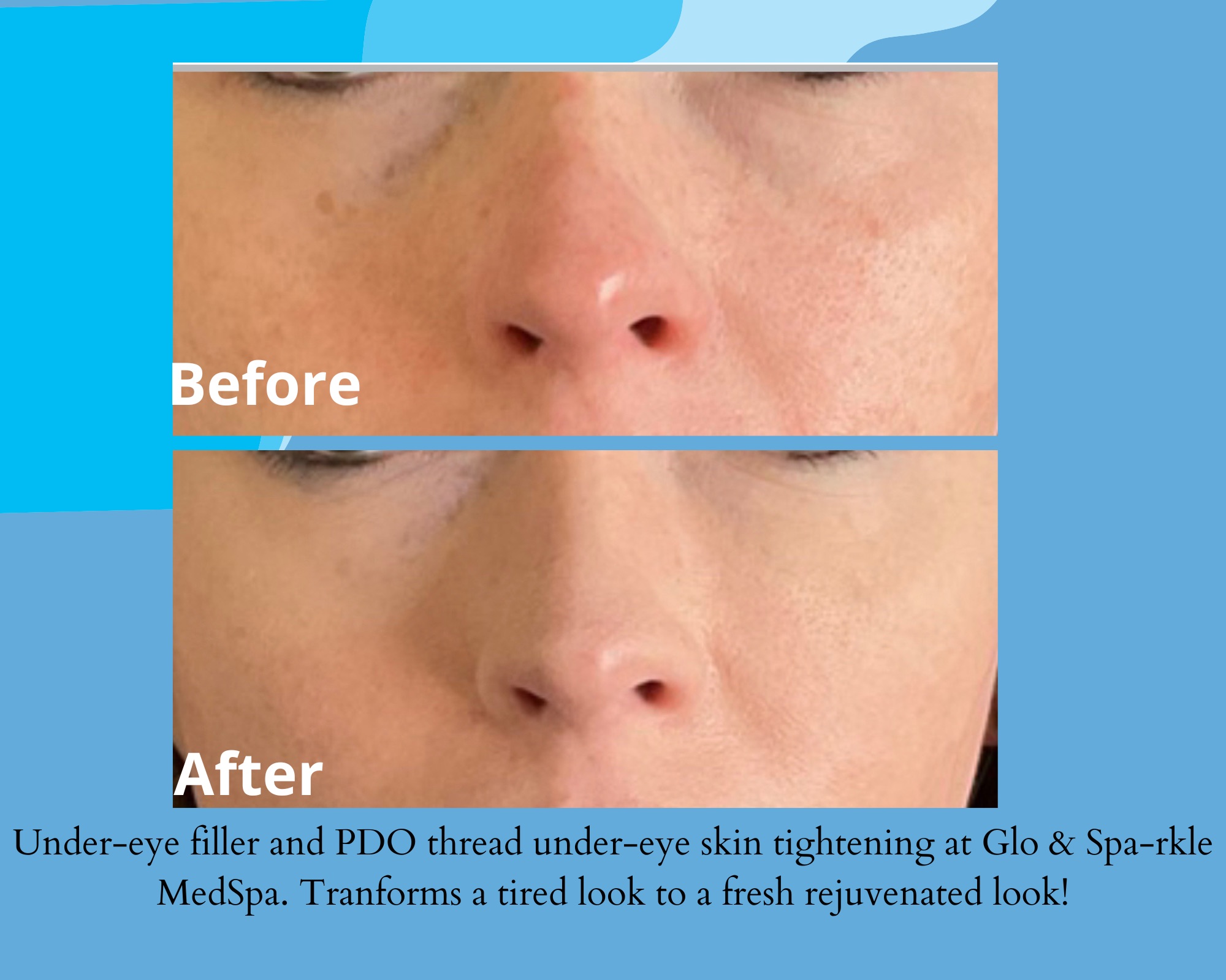 Under-Eye Rejuvenation Before & After Image