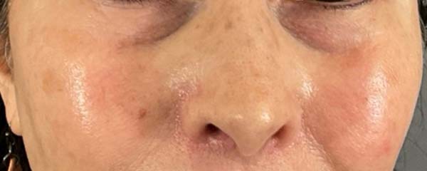 Under-Eye Rejuvenation Before & After Image