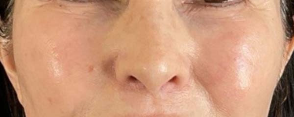 Under-Eye Rejuvenation Before & After Image