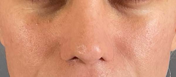 Under-Eye Rejuvenation Before & After Image