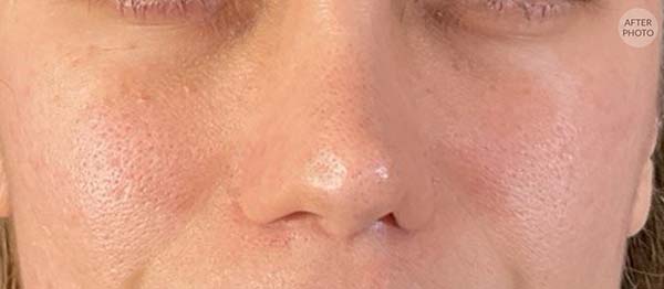 Under-Eye Rejuvenation Before & After Image