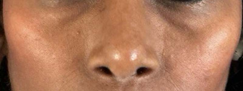 Under-Eye Rejuvenation Before & After Image