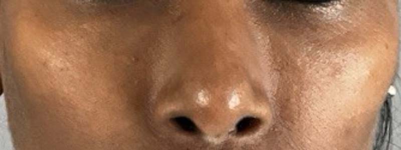 Under-Eye Rejuvenation Before & After Image