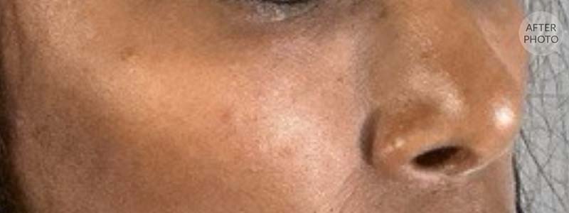 Under-Eye Rejuvenation Before & After Image