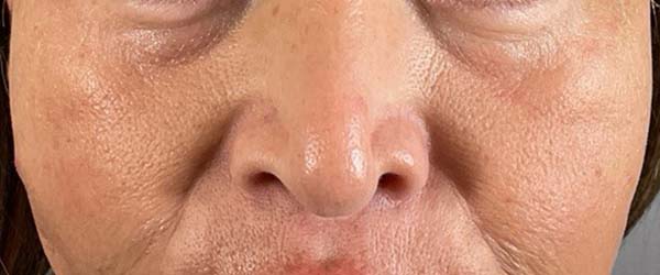 Under-Eye Rejuvenation Before & After Image