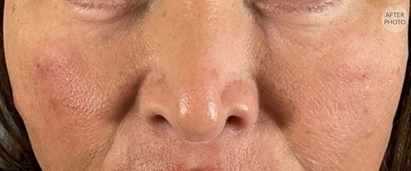 Under-Eye Rejuvenation Before & After Image