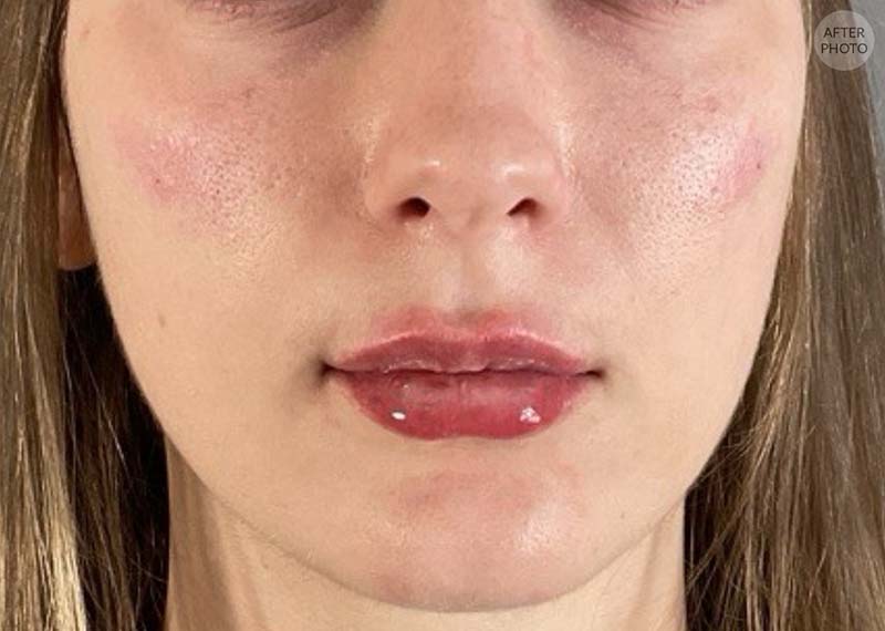 Under-Eye Rejuvenation Before & After Image