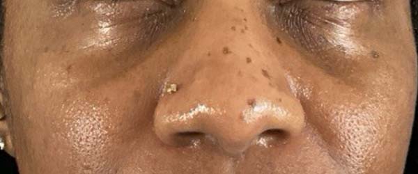 Under-Eye Rejuvenation Before & After Image