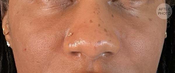 Under-Eye Rejuvenation Before & After Image