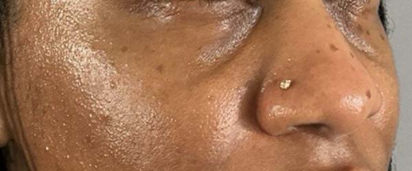 Under-Eye Rejuvenation Before & After Image