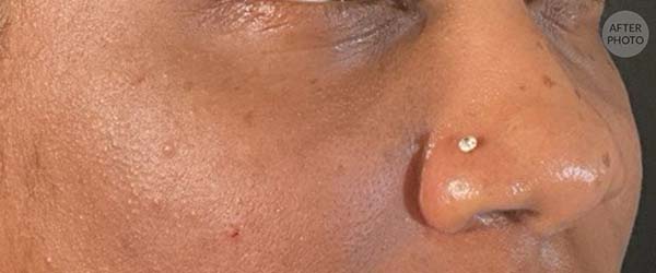 Under-Eye Rejuvenation Before & After Image