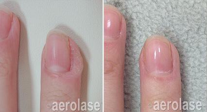 Wart Removal Before & After Image