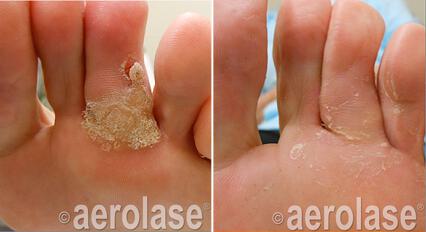 Wart Removal Before & After Image